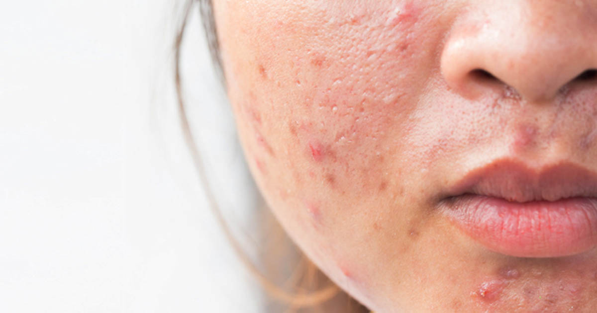 ৭ দিনে ব্রণ দূর করার উপায়